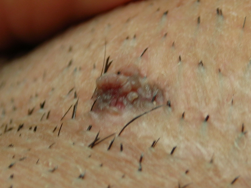 Moles - The Skin Center: Board-Certified Dermatologists ...